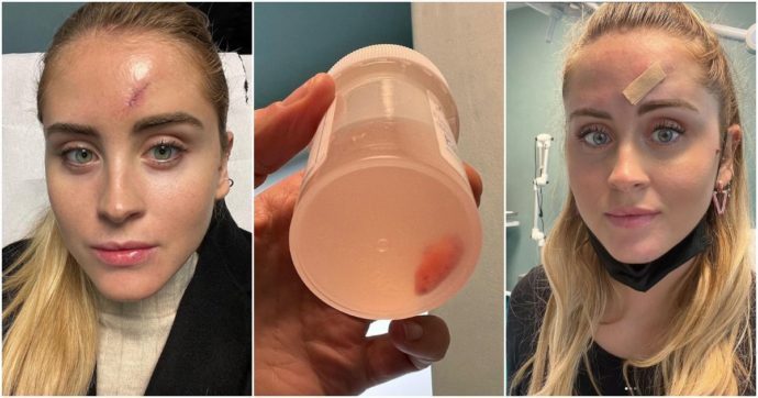 Valentina Ferragni confessa su Instagram: “Tolto un tumore maligno sulla fronte. Prevenzione è fondamentale”