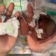 E’ Curtis il bambino più prematuro del mondo: è nato a 21 settimane e 1 giorno