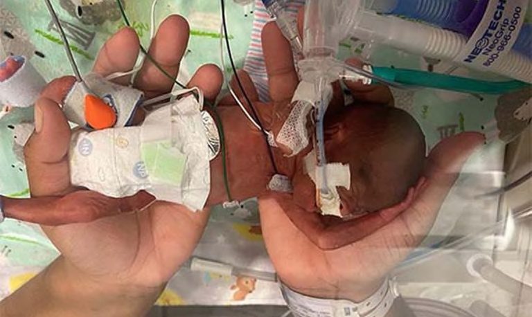 E’ Curtis il bambino più prematuro del mondo: è nato a 21 settimane e 1 giorno