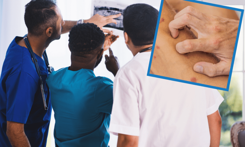 L'aumento di settimana in settimana dei casi di vaiolo delle scimmie preoccupa l'Europa che cerca di correre ai ripari con i vaccini già efficaci contro il vaiolo.