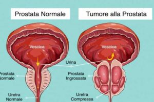 Salute, in Sicilia il cancro alla prostata è il più diffuso tra gli uomini: i numeri più alti a Siracusa e Catania