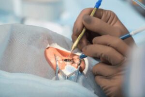 Catania, infezioni dopo interventi di cataratta in una clinica privata: Procura indaga su ricoveri e danni ai pazienti