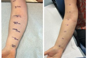 Catania, al ‘Cannizzaro’ primo Linfo-DIEP: tecnica d'avanguardia per le donne operate di tumore al seno