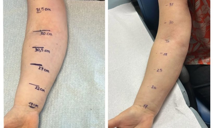 Catania, al ‘Cannizzaro’ primo Linfo-DIEP: tecnica d'avanguardia per le donne operate di tumore al seno